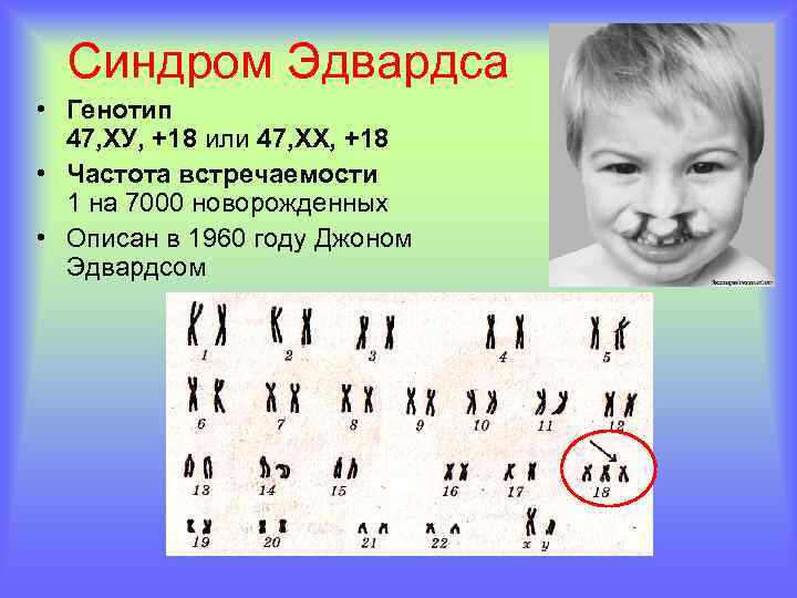 Синдром Эдвардса • Генотип 47, ХУ, +18 или 47, ХХ, +18 • Частота встречаемости