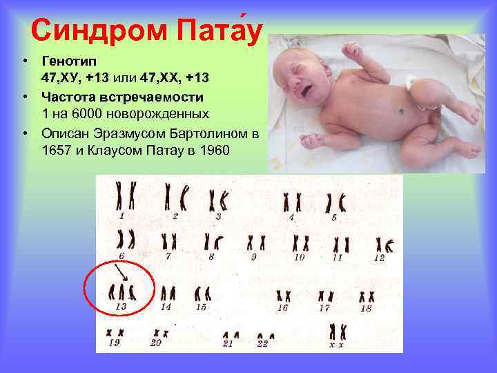 Синдром Пата у • Генотип 47, ХУ, +13 или 47, ХХ, +13 • Частота
