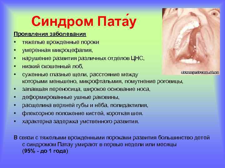 Синдром Пата у Проявления заболевания • тяжелые врожденные пороки • умеренная микроцефалия, • нарушение