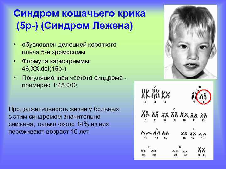 Синдром кошачьего крика (5 р-) (Синдром Лежена) • обусловлен делецией короткого плеча 5 -й