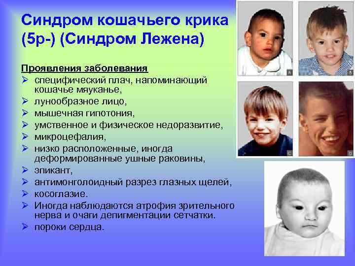 Синдром кошачьего крика (5 р-) (Синдром Лежена) Проявления заболевания Ø специфический плач, напоминающий кошачье