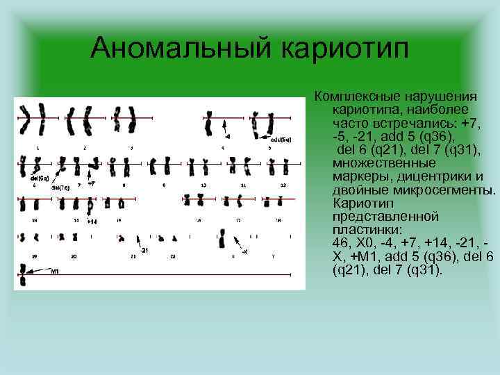 Аномальный кариотип Комплексные нарушения кариотипа, наиболее часто встречались: +7, -5, -21, add 5 (q