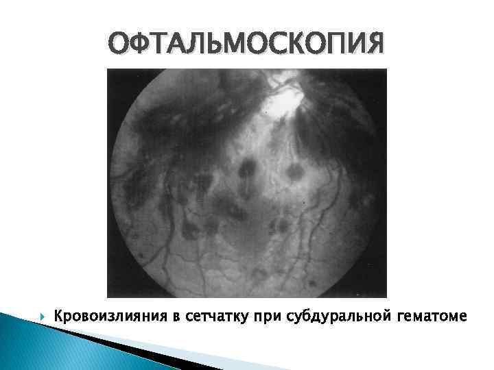 ОФТАЛЬМОСКОПИЯ Кровоизлияния в сетчатку при субдуральной гематоме 