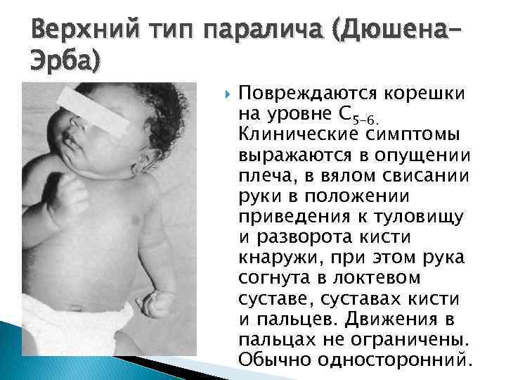 Верхний тип паралича (Дюшена. Эрба) Повреждаются корешки на уровне С 5 -6. Клинические симптомы