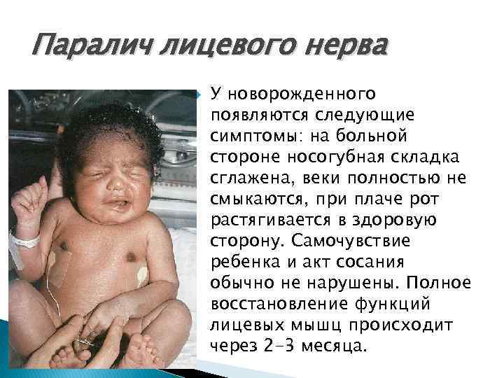 Паралич лицевого нерва У новорожденного появляются следующие симптомы: на больной стороне носогубная складка сглажена,