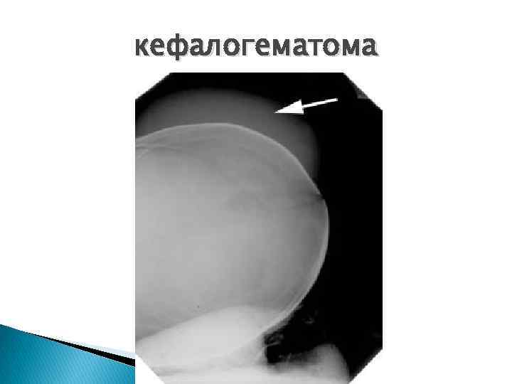 кефалогематома 