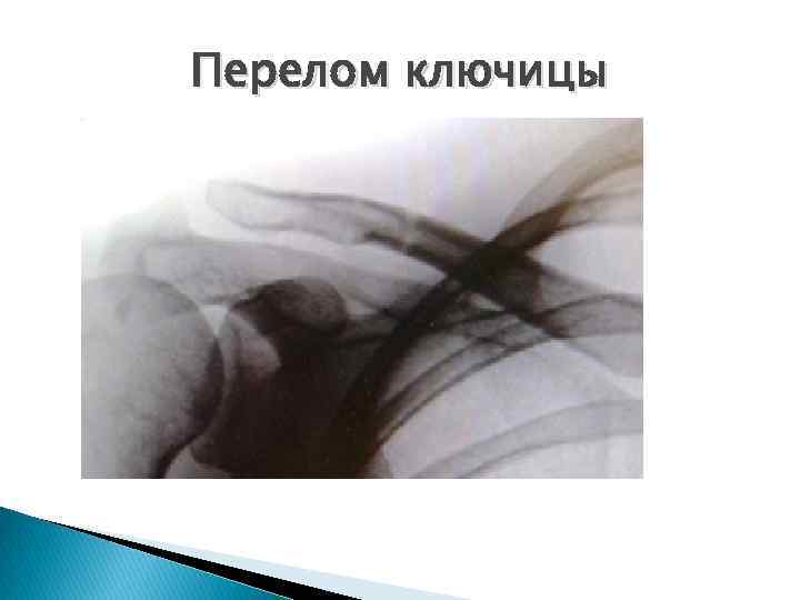 Перелом ключицы 