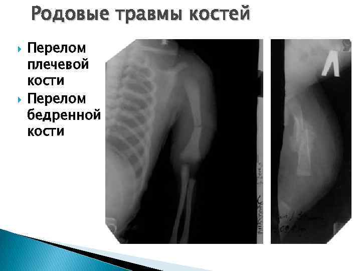 Родовые травмы костей Перелом плечевой кости Перелом бедренной кости 