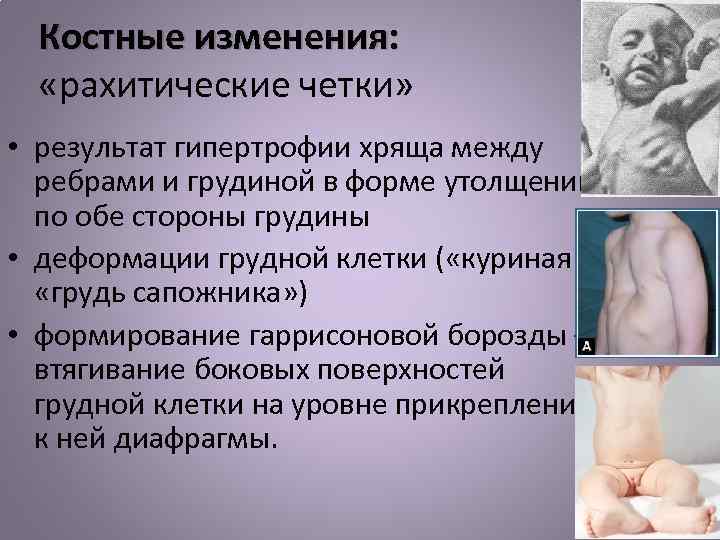 Костные изменения: «рахитические четки» • результат гипертрофии хряща между ребрами и грудиной в форме