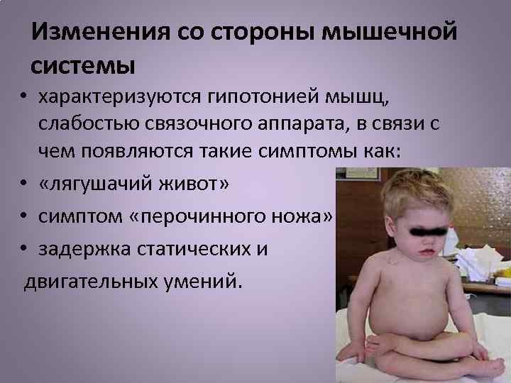 Изменения со стороны мышечной системы • характеризуются гипотонией мышц, слабостью связочного аппарата, в связи