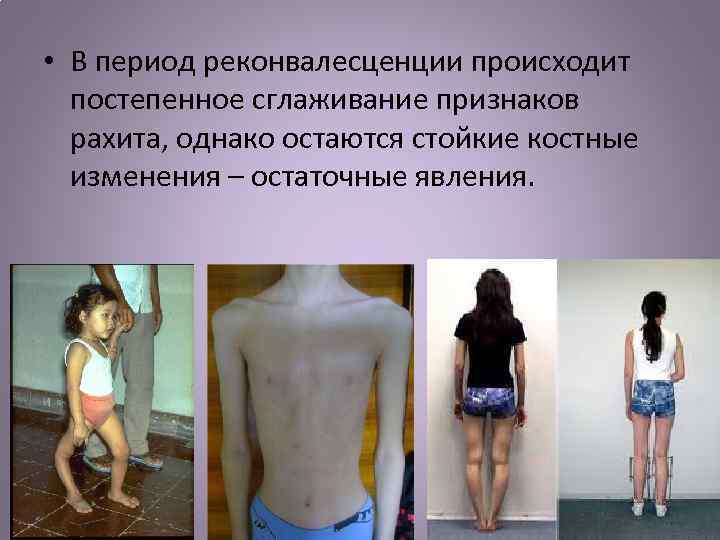  • В период реконвалесценции происходит постепенное сглаживание признаков рахита, однако остаются стойкие костные