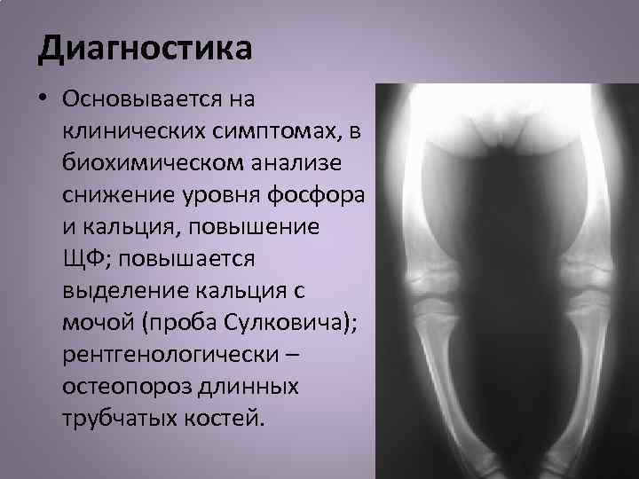 Диагностика • Основывается на клинических симптомах, в биохимическом анализе снижение уровня фосфора и кальция,
