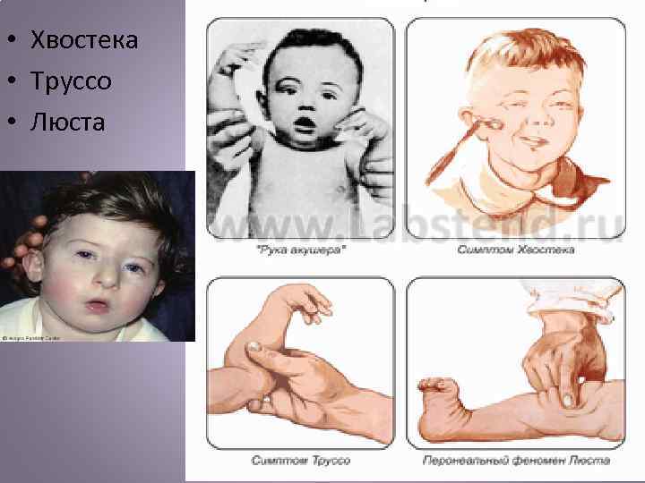  • Хвостека • Труссо • Люста 