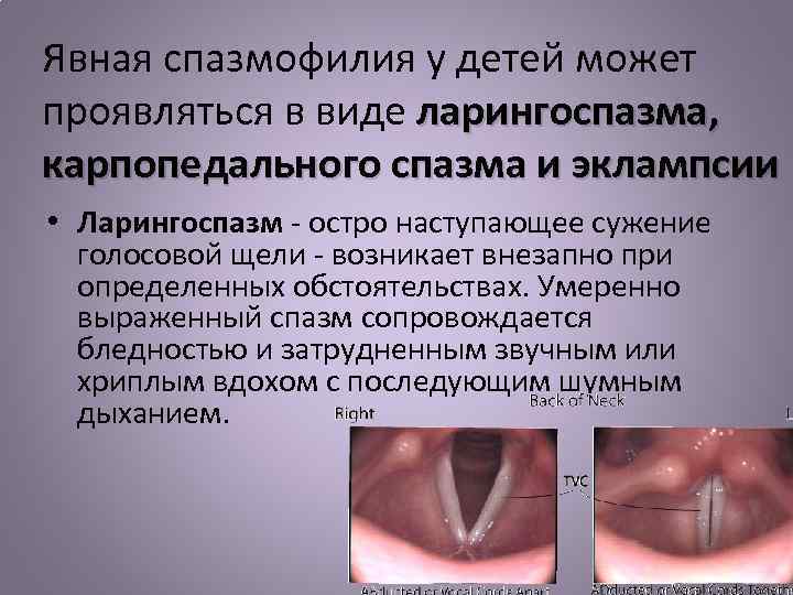 Явная спазмофилия у детей может проявляться в виде ларингоспазма, карпопедального спазма и эклампсии •