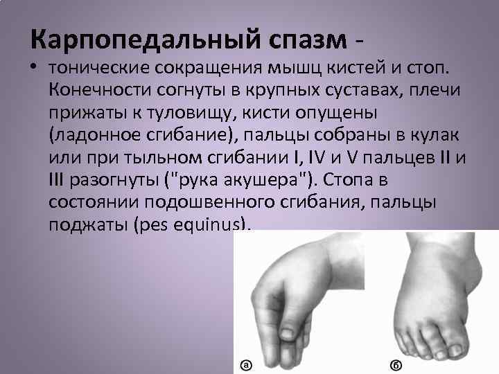 Карпопедальный спазм - • тонические сокращения мышц кистей и стоп. Конечности согнуты в крупных