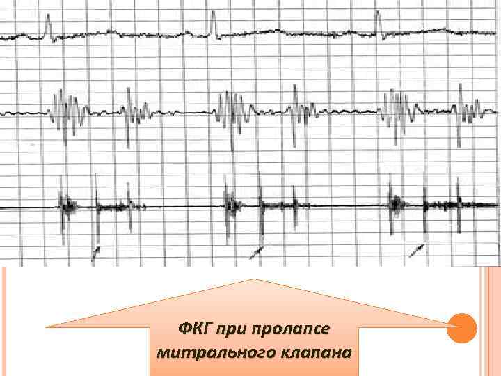 ФКГ при пролапсе митрального клапана 