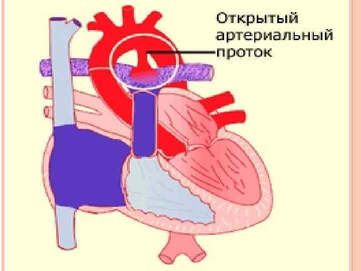 Оап у новорожденных. Открытый артериальный (боталлов) проток (ОАП). Открытый артериальный проток Баталов. Открытое артериальный проток у новорожденных. ВПС: - открытый Баталов проток.