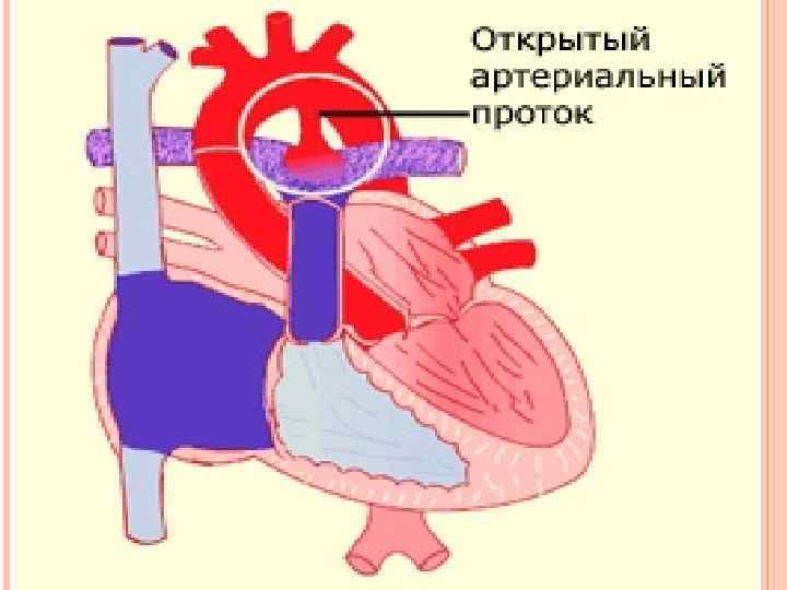 Открытый артериальный проток у детей