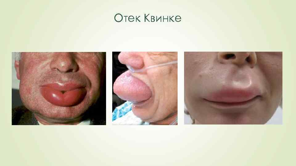 Отек Квинке 