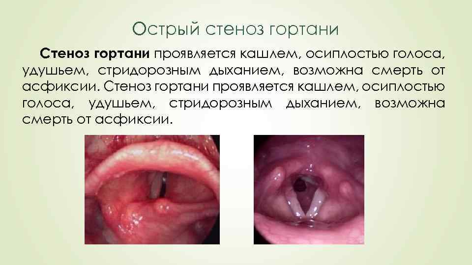 Острый стеноз гортани Стеноз гортани проявляется кашлем, осиплостью голоса, удушьем, стридорозным дыханием, возможна смерть