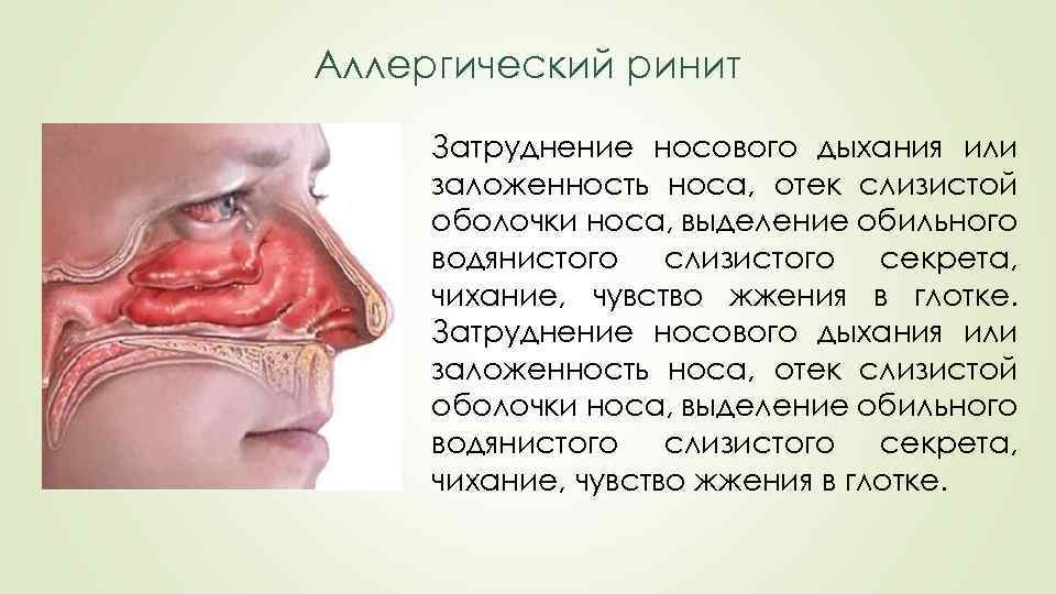 Аллергический ринит Затруднение носового дыхания или заложенность носа, отек слизистой оболочки носа, выделение обильного