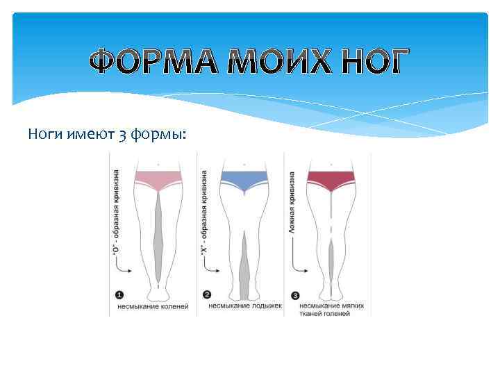 ФОРМА МОИХ НОГ Ноги имеют 3 формы: 