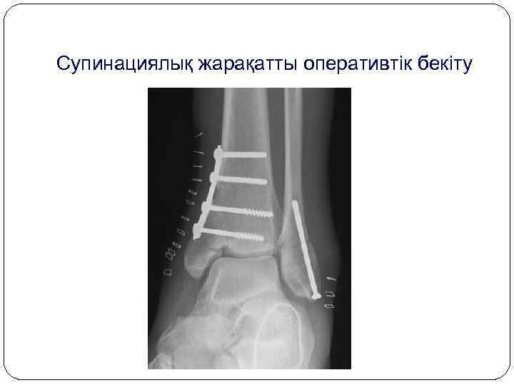 Супинациялық жарақатты оперативтік бекіту 