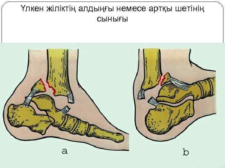 Үлкен жіліктің алдыңғы немесе артқы шетінің сынығы 