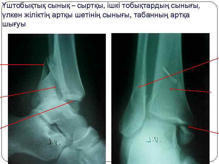 Үштобықтық сынық – сыртқы, ішкі тобықтардың сынығы, үлкен жіліктің артқы шетінің сынығы, табанның артқа