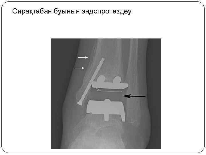 Сирақтабан буынын эндопротездеу 