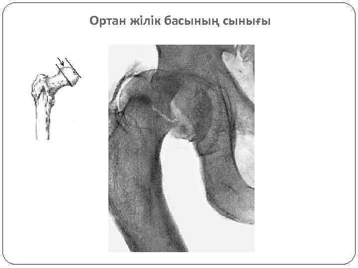 Ортан жілік басының сынығы 