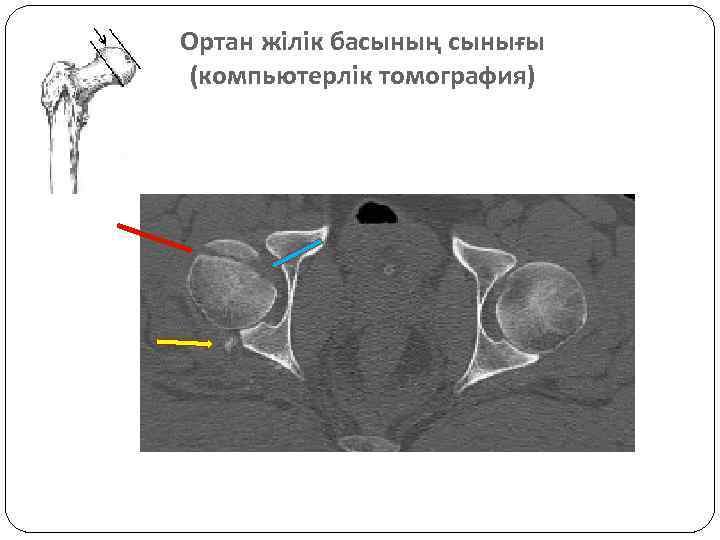 Ортан жілік басының сынығы (компьютерлік томография) 