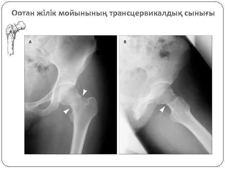 Ортан жілік мойынының трансцервикалдық сынығы 