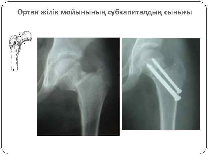 Ортан жілік мойынының субкапиталдық сынығы 