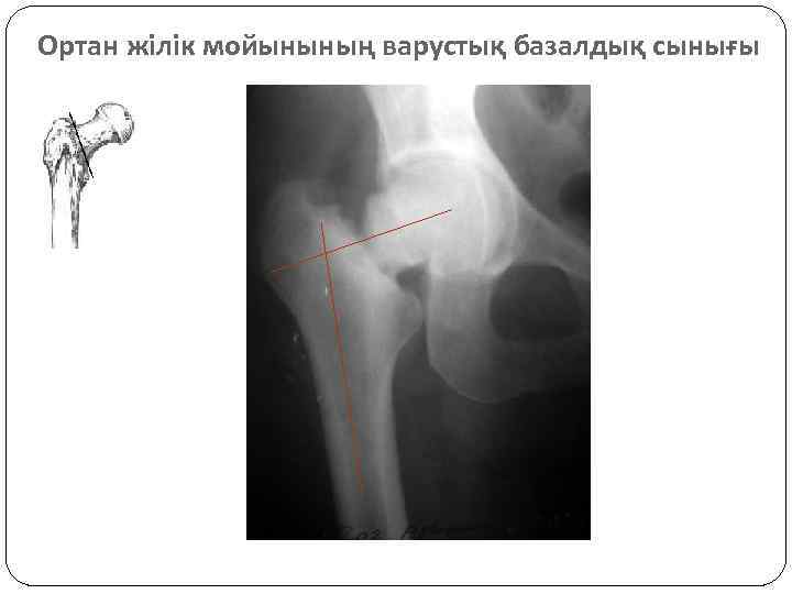 Ортан жілік мойынының варустық базалдық сынығы 