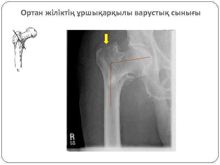 Ортан жіліктің ұршықарқылы варустық сынығы 