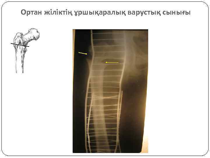 Ортан жіліктің ұршықаралық варустық сынығы 