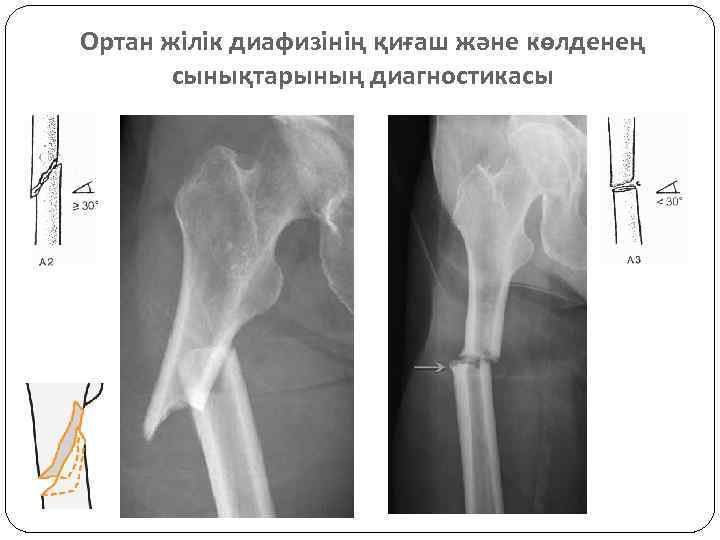 Ортан жілік диафизінің қиғаш және көлденең сынықтарының диагностикасы 