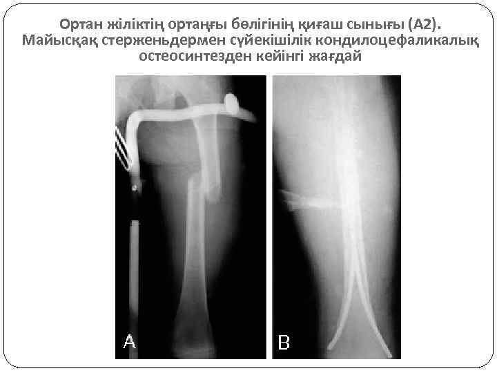 Ортан жіліктің ортаңғы бөлігінің қиғаш сынығы (А 2). Майысқақ стерженьдермен сүйекішілік кондилоцефаликалық остеосинтезден кейінгі