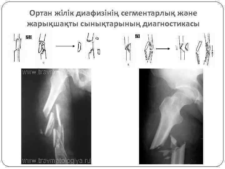 Ортан жілік диафизінің сегментарлық және жарықшақты сынықтарының диагностикасы 