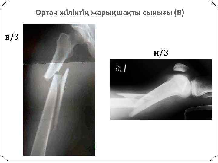 Ортан жіліктің жарықшақты сынығы (В) в/3 н/3 