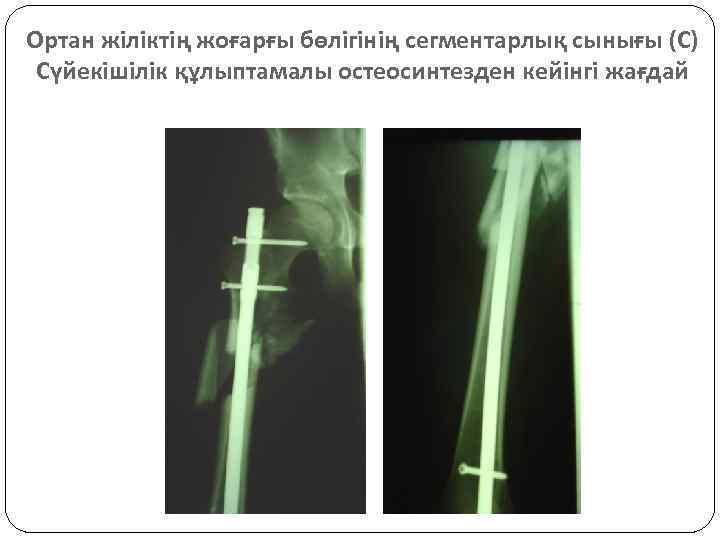 Ортан жіліктің жоғарғы бөлігінің сегментарлық сынығы (С) Сүйекішілік құлыптамалы остеосинтезден кейінгі жағдай 