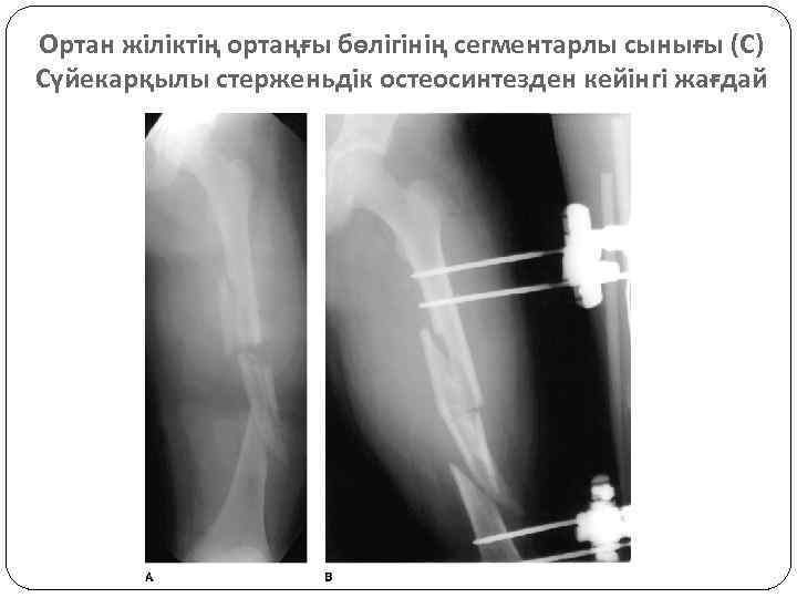 Ортан жіліктің ортаңғы бөлігінің сегментарлы сынығы (С) Сүйекарқылы стерженьдік остеосинтезден кейінгі жағдай 