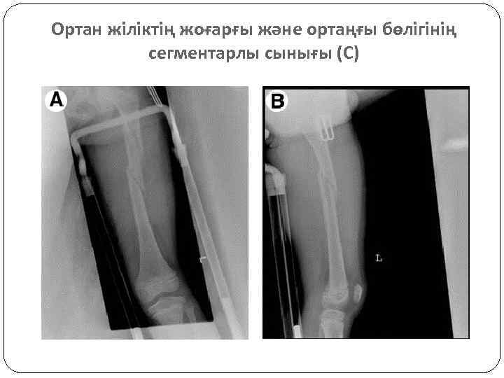 Ортан жіліктің жоғарғы және ортаңғы бөлігінің сегментарлы сынығы (С) 