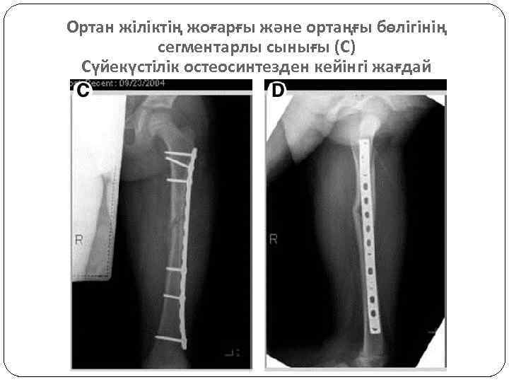 Ортан жіліктің жоғарғы және ортаңғы бөлігінің сегментарлы сынығы (С) Сүйекүстілік остеосинтезден кейінгі жағдай 