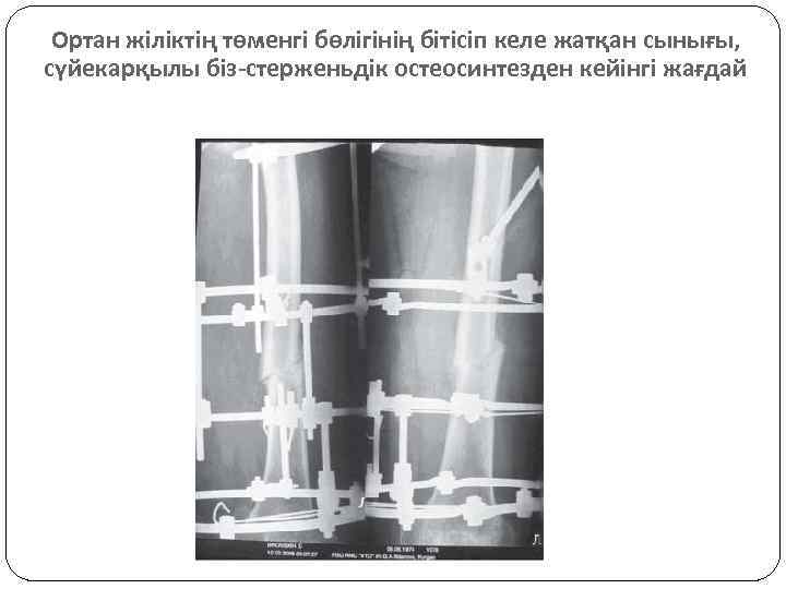 Ортан жіліктің төменгі бөлігінің бітісіп келе жатқан сынығы, сүйекарқылы біз-стерженьдік остеосинтезден кейінгі жағдай 