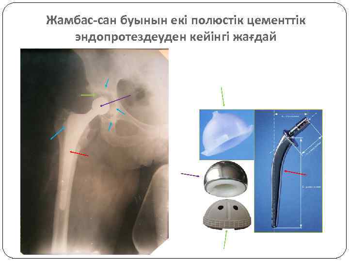 Жамбас-сан буынын екі полюстік цементтік эндопротездеуден кейінгі жағдай 