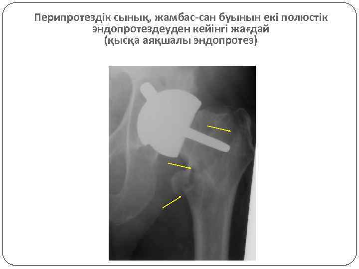 Перипротездік сынық, жамбас-сан буынын екі полюстік эндопротездеуден кейінгі жағдай (қысқа аяқшалы эндопротез) 