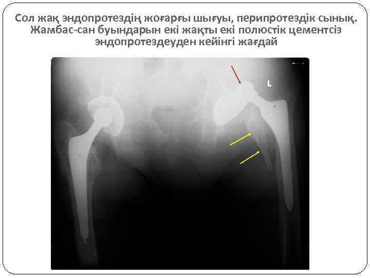 Сол жақ эндопротездің жоғарғы шығуы, перипротездік сынық. Жамбас-сан буындарын екі жақты екі полюстік цементсіз