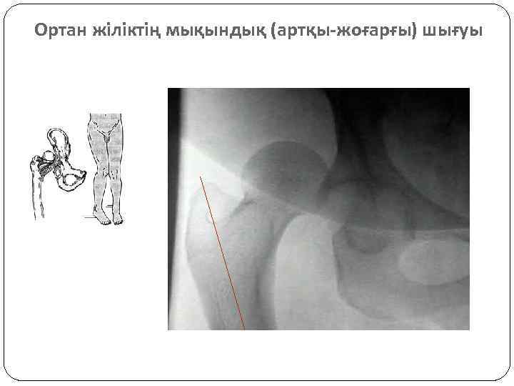 Ортан жіліктің мықындық (артқы-жоғарғы) шығуы 